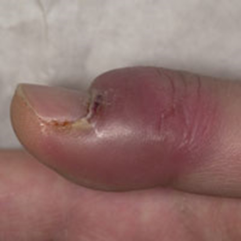 finger infection