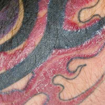 Can I Be Allergic To My Tattoo? Tattoo Removal Toronto