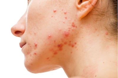 Acne: causes, diagnosis and treatment