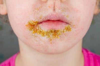 Impetigo: causes, symptoms and diagnosis