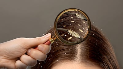 Superdrug headlice spray sales spike 121% amid ‘warmer weather’