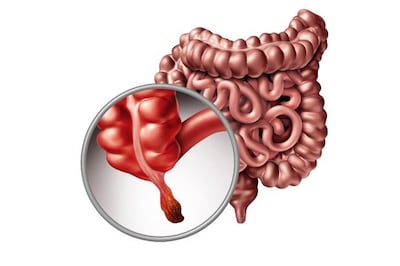 Appendicitis: diagnosis and treatment